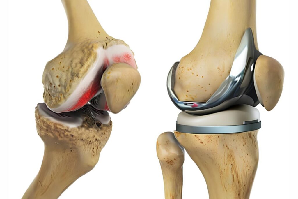 Total knee replacement – Manual and Active Robotic Arm Assisted