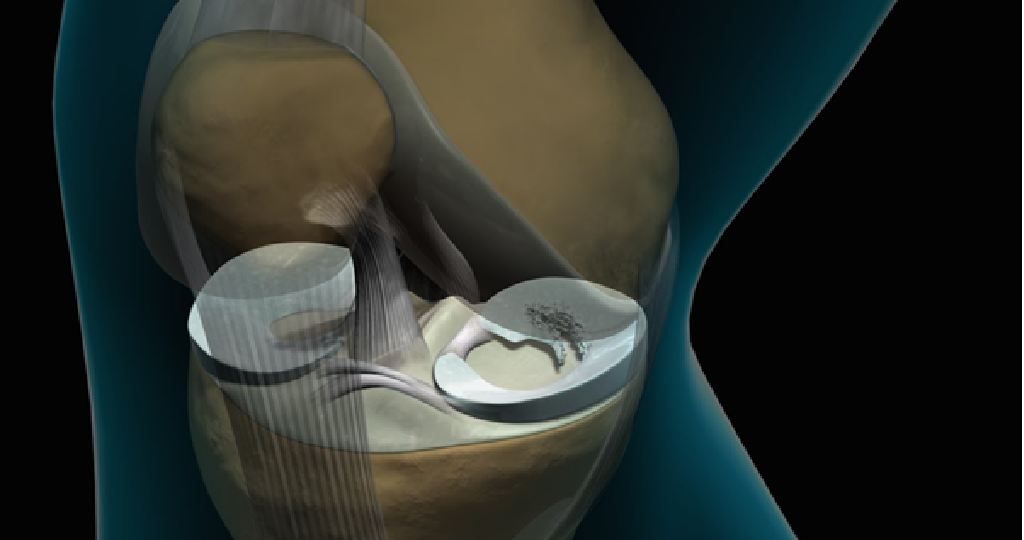 Arthroscopic Surgery- Knee and Hip – Both Diagnostic and Therapeutic