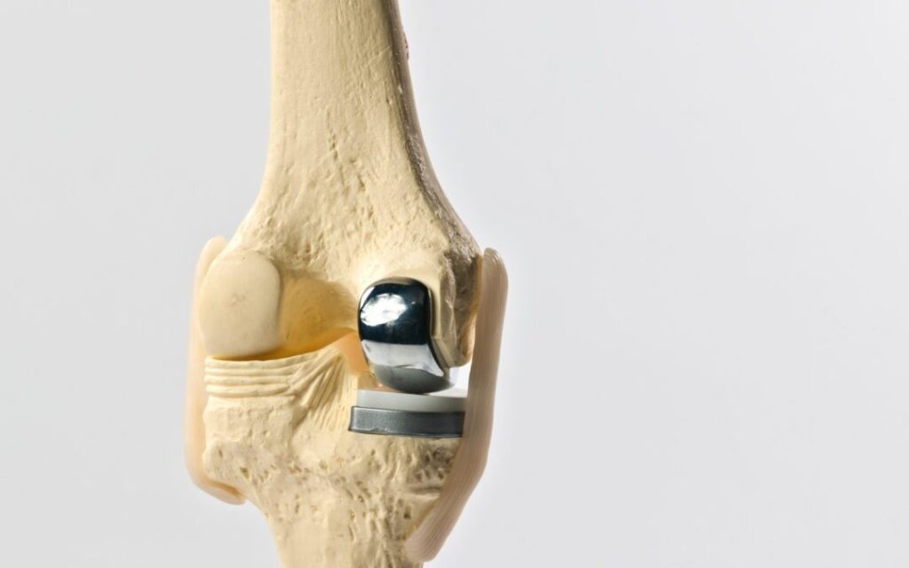 Unicondylar Knee replacement – Manual and Active Robotic Arm Assisted